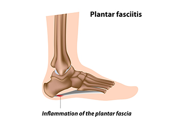 How High Heels Affect Nerves in Your Feet: Arlington/Mansfield